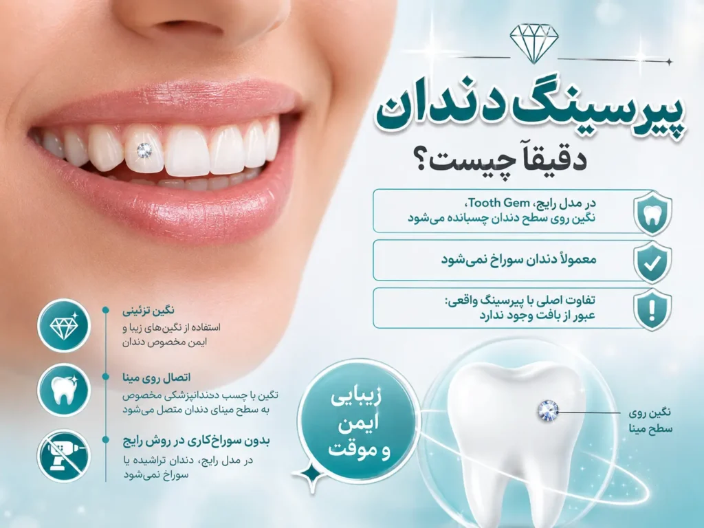 زیور دندان چگونه روی مینای دندان می‌ماند؟